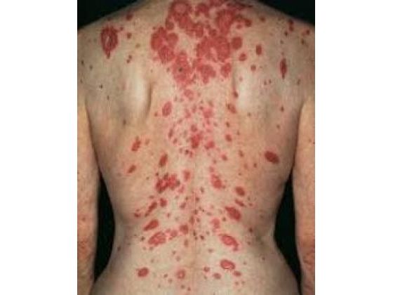 Lupus Rashes Elicit Pervasive Skin Changes.