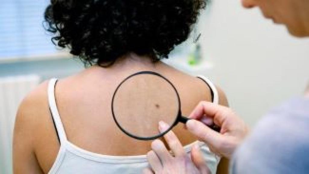 Melanoma Skin Cancer Discover More About It