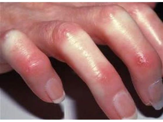 Scleroderma Can Be Disfiguring
