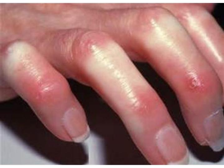 Scleroderma Can Be Disfiguring