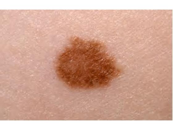 Skin Cancer: Precautions To Reduce Your Risks
