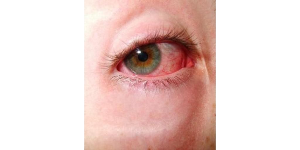 Speedily Attend To Red Itchy Burning Eyes