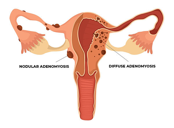Gambar Adenomyosis