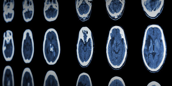 CT scan otak menunjukkan stroke iskemik