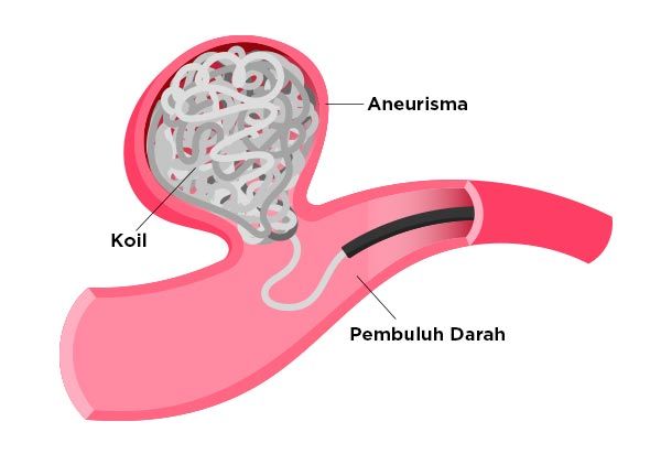 Visualisi Koil pada Embolisasi Aneurisma pada Pembuluh Darah Otak