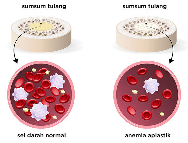 Gambar Anemia Aplastik