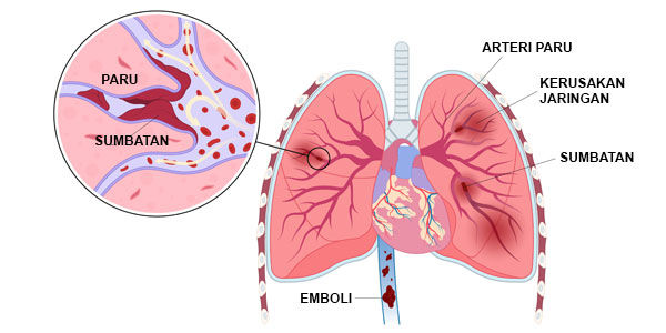 Emboli Paru Penyebab Gejala Pengobatan Dan Pencegahannya Rumah