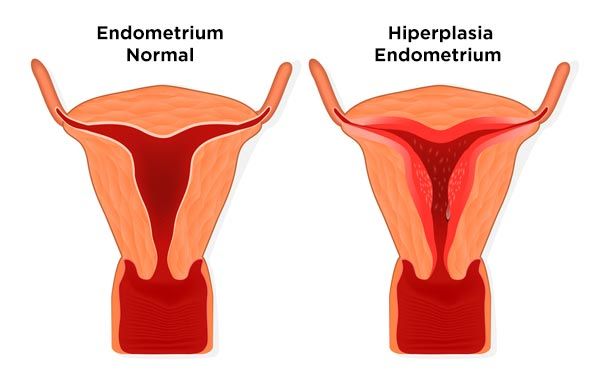Gambar Penebalan Dinding Rahim / Hiperplasia Endometrium