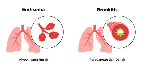 Kondisi Paru pada Bronkitis dan Emfisema