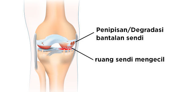 Kondisi Pengapuran Tulang
