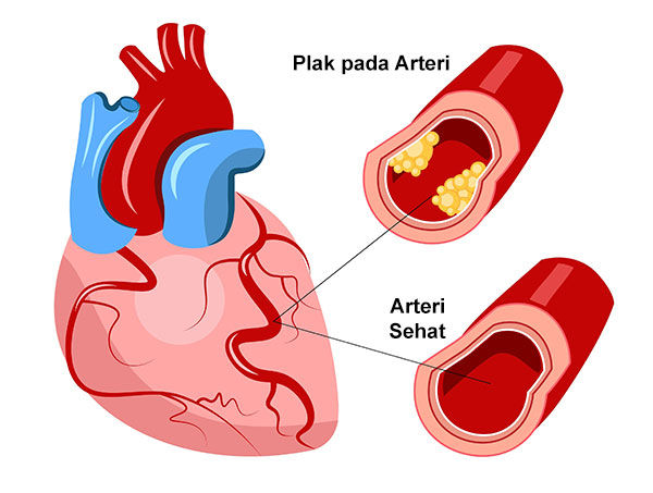 Gambar Penyakit Arteri Koroner