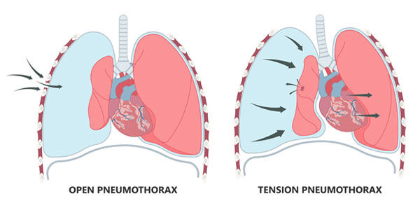 Gambar Kondisi Pneumothorax