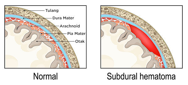 Gambar Subdural Hematoma