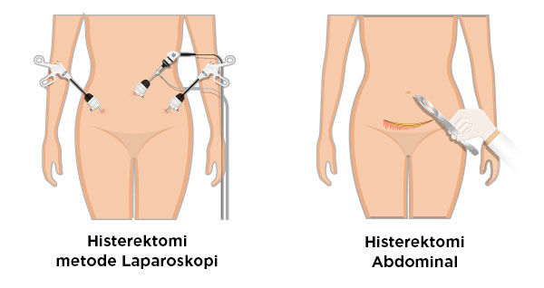 Gambar Prosedur Bedah Histerektomi