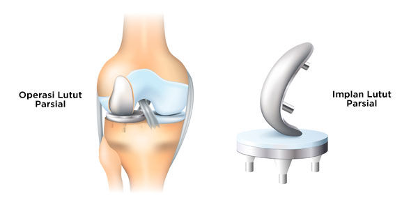 Operasi Lutut Parsial