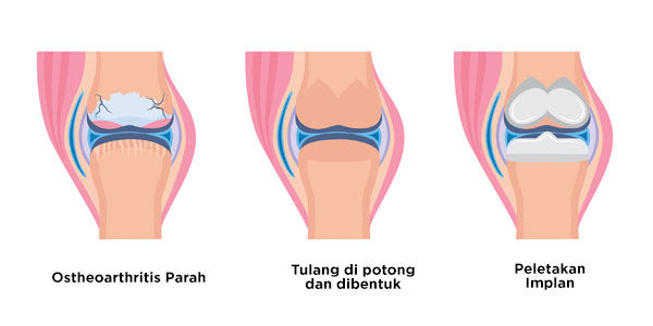 Operasi Lutut Total