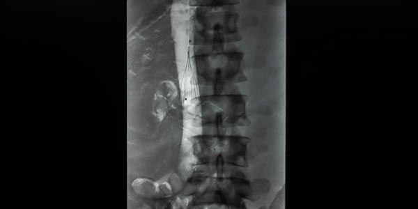 Visualisasi Pemasangan Filter Vena Cava
