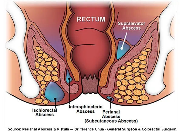 Visualisasi Abses Perianal