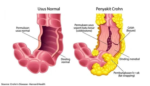 Visualisasi Kondisi Crohn's Disease