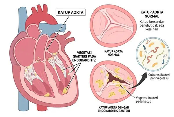 Visualisasi Endokarditis