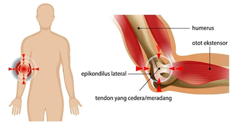 Visualisasi Lateral Epicondylitis