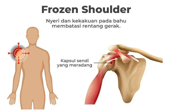 Visualisasi Frozen Shoulder