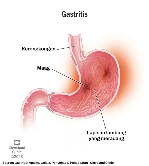 visualisasi gastritis
