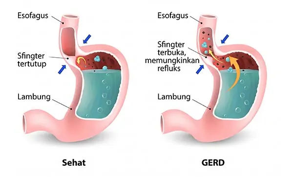 Visualisasi GERD