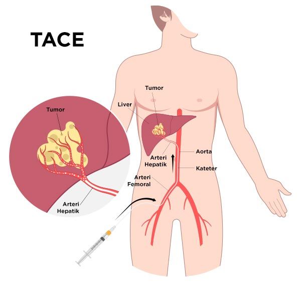 Visualisasi Prosedur TACE