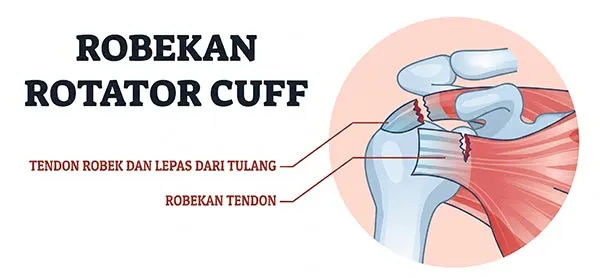 Visualisasi Rotator Cuff Injury