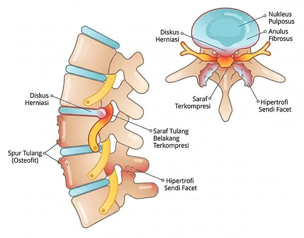 Visualisasi Spinal Stenosis