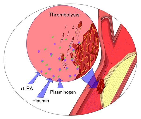 Visualisasi Trombolisis pada Stroke Iskemik Akut