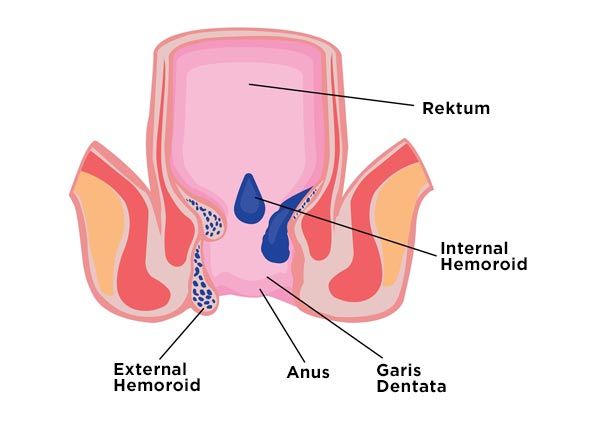 Visualisasi Wasir (Hemoroid)