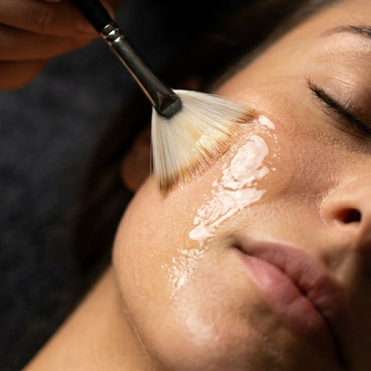Peeling Químico
