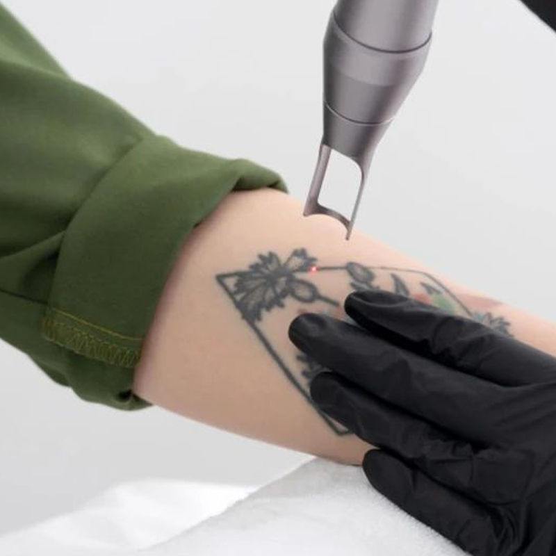Láser removedor de tatuajes