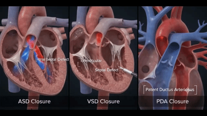 Closure device sealing a septal defect between the heart chambers