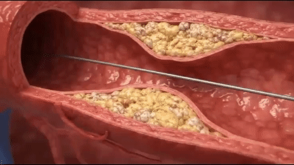 Complex coronary angioplasty with a stent being deployed in a narrowed artery