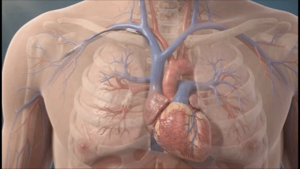 Implantable cardioverter-defibrillator leads positioned within the heart