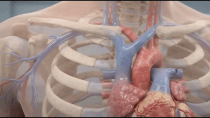 Permanent pacemaker leads placed within the heart chambers