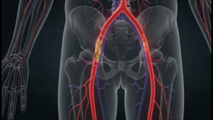 Balloon angioplasty reopening a narrowed artery in the leg