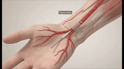 Coronary angiography catheter entering the heart via the radial artery at the wrist