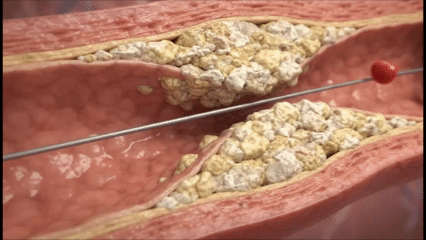 Diamond-tipped rotational atherectomy burr clearing calcified plaque