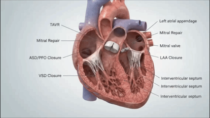 Catheter delivering a structural heart device to the heart