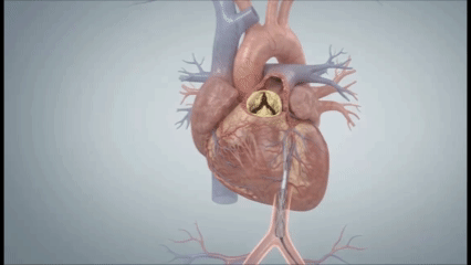 Transcatheter aortic valve replacement device positioned across the aortic valve