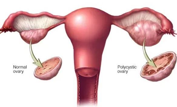 PCOS-Ovaries