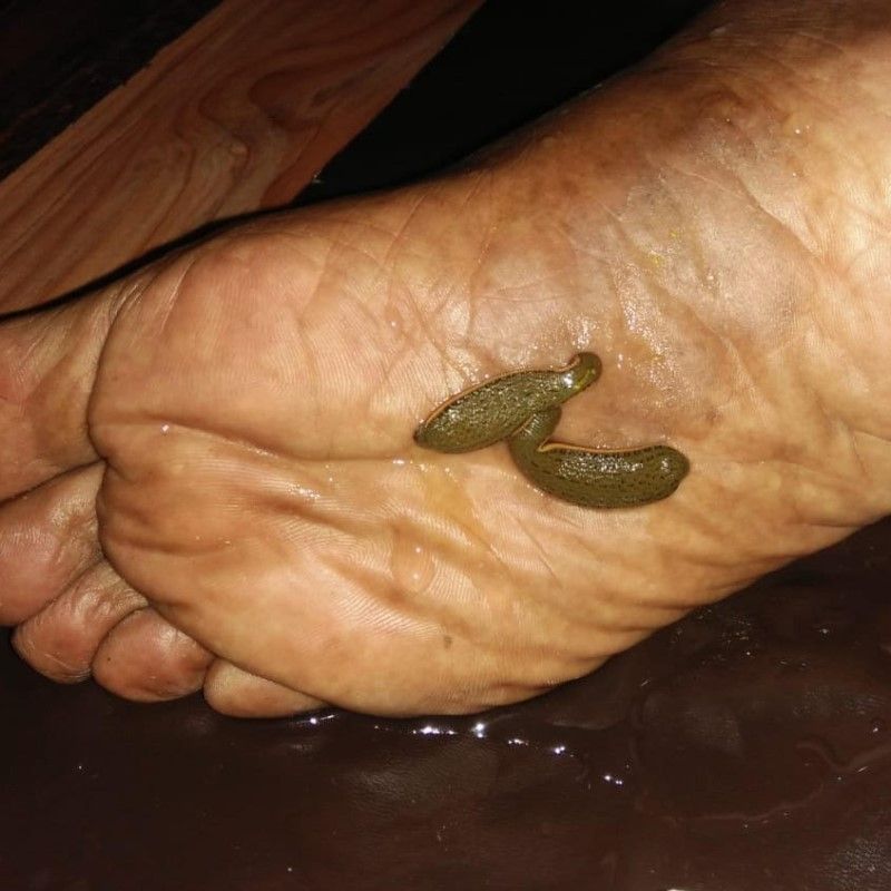 Ayurveda-Leech-Therapy