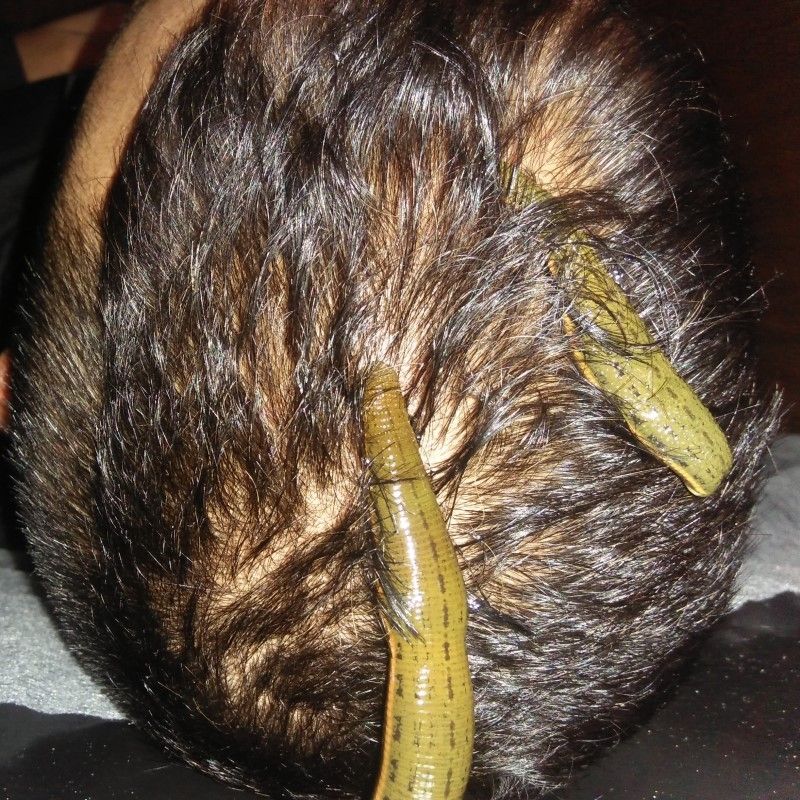 Leech-Therapy-Hairfall