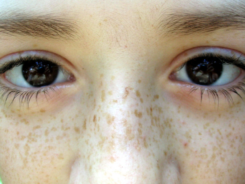 ilustrasi freckles pada wajah