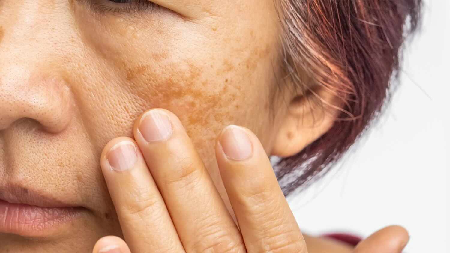 ilustrasi melasma pada wajah