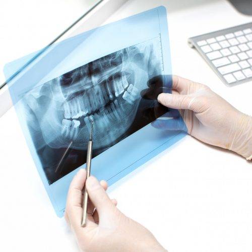Dental X-Rays are safe
